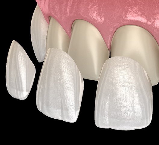 3D model of four porcelain veneers being placed on smile