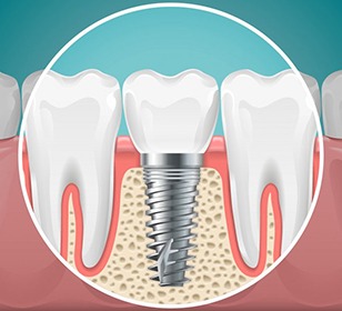 illustration of a dental implant fusing to the jawbone 
