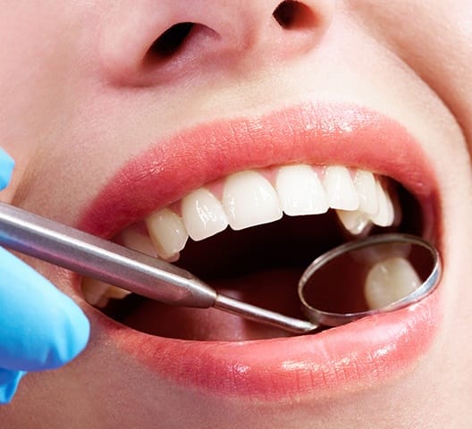 Dentist checking smile after placing a tooth colored filling