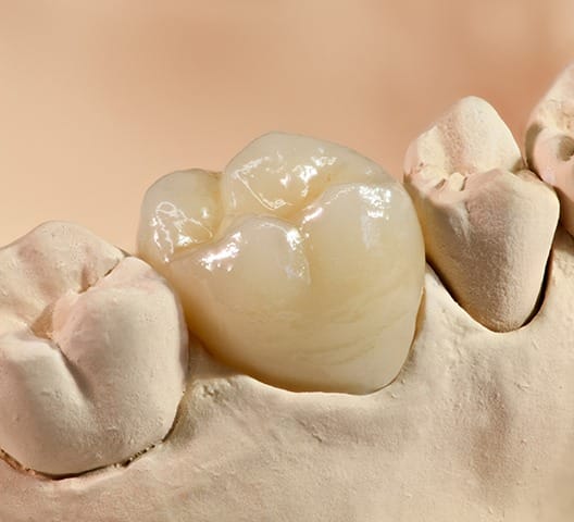 Model smile with dental crown restoration