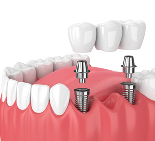 Illustration of implant bridge