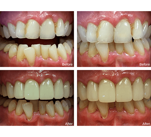 Woman's smile compared with porcelain veneer shared chart