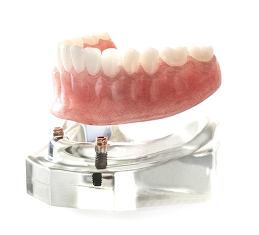 Implant dentures in Doylestown