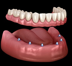 model of an implant denture on the lower arch 