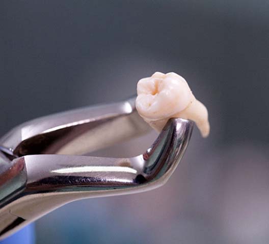 Extracted tooth in Doylestown being held by forceps