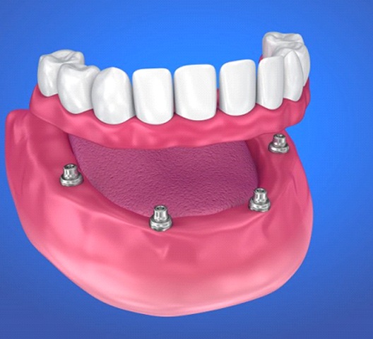 illustration of how implant dentures in Doylestown work