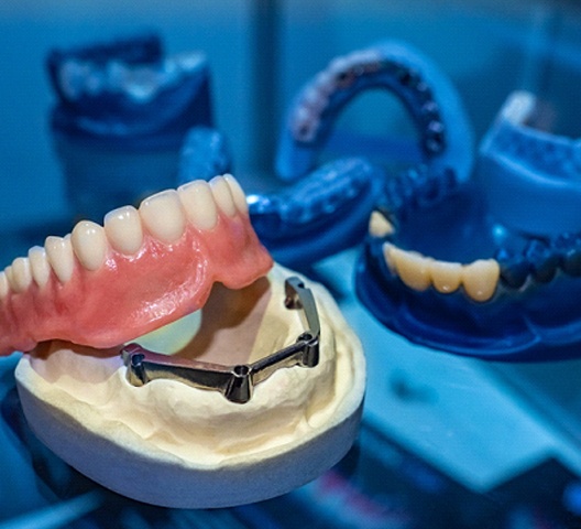 model of an implant denture