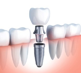 Digital illustration of the different parts of a dental implant 