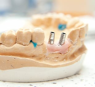 Model smile with dental implants in place for replacement teeth
