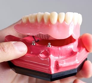 Model dental impant supported denture