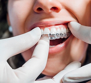 Dentist with white gloves placing aligner on patient's teeth