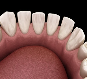 Example of tooth gaps in Doylestown
