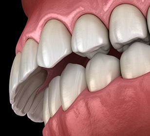 Example of overbite in Doylestown