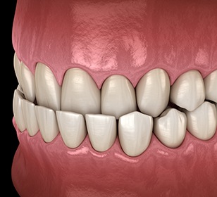 Example of underbite in Doylestown