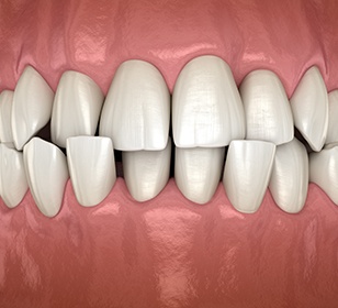 Example of crossbite in Doylestown