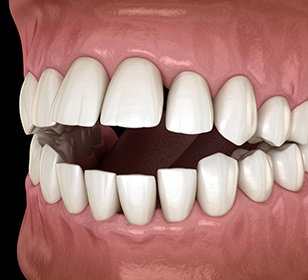 Example of open bite in Doylestown