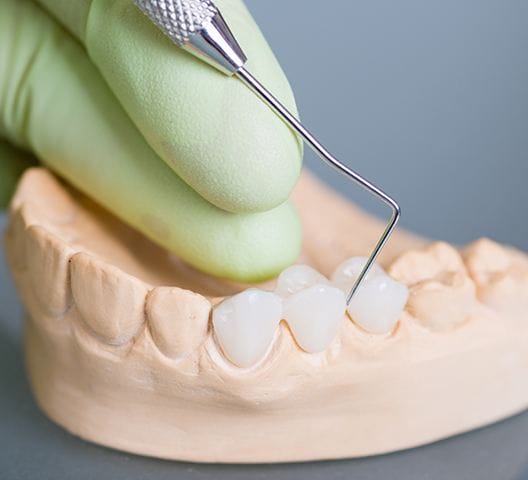 Model smile with dental bridge restoration