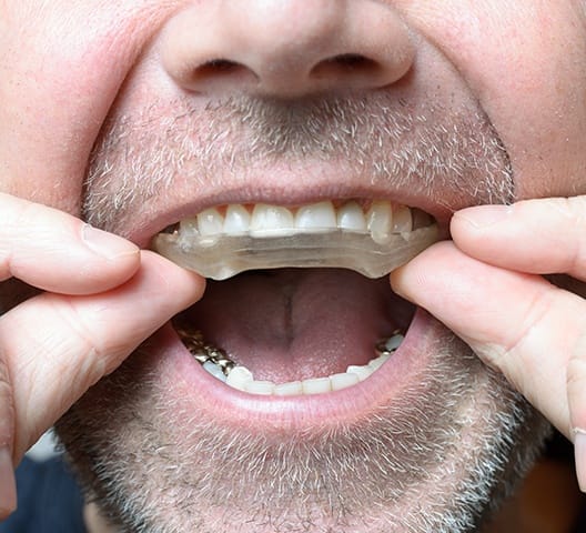 Man placing nightguard for bruxism