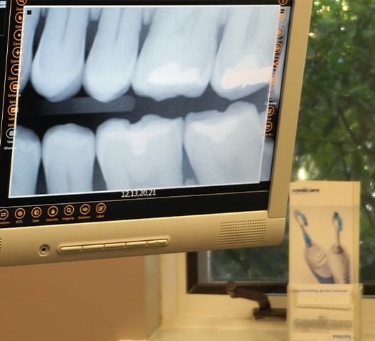 Digital dental x-rays on chairside computer monitor