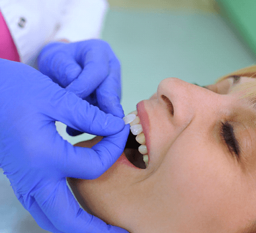 procedure for female patient getting veneers