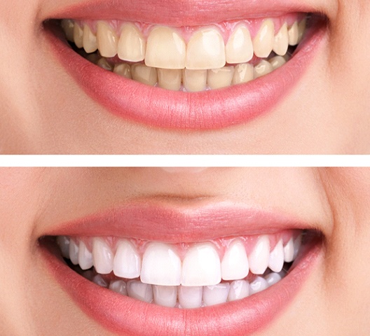 Close-up of woman’s smile before and after whitening