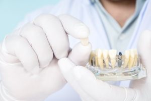 Close-up of hands holding model with dental implants and restorations