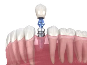 Model of dental implant components 