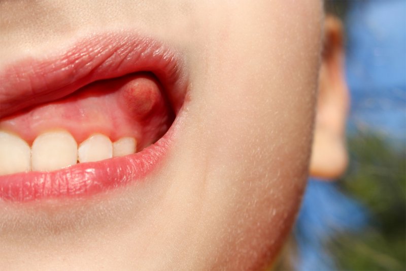 A close-up of a bump on gums