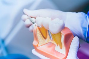 Dentist holding a large model of a dental implant with gloved hands pointing to it with a dental instrument